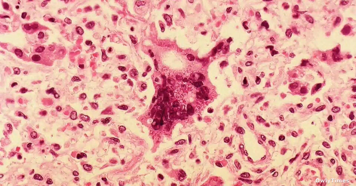 PA Measles Exposure: A Signal of Shifting Immunity?