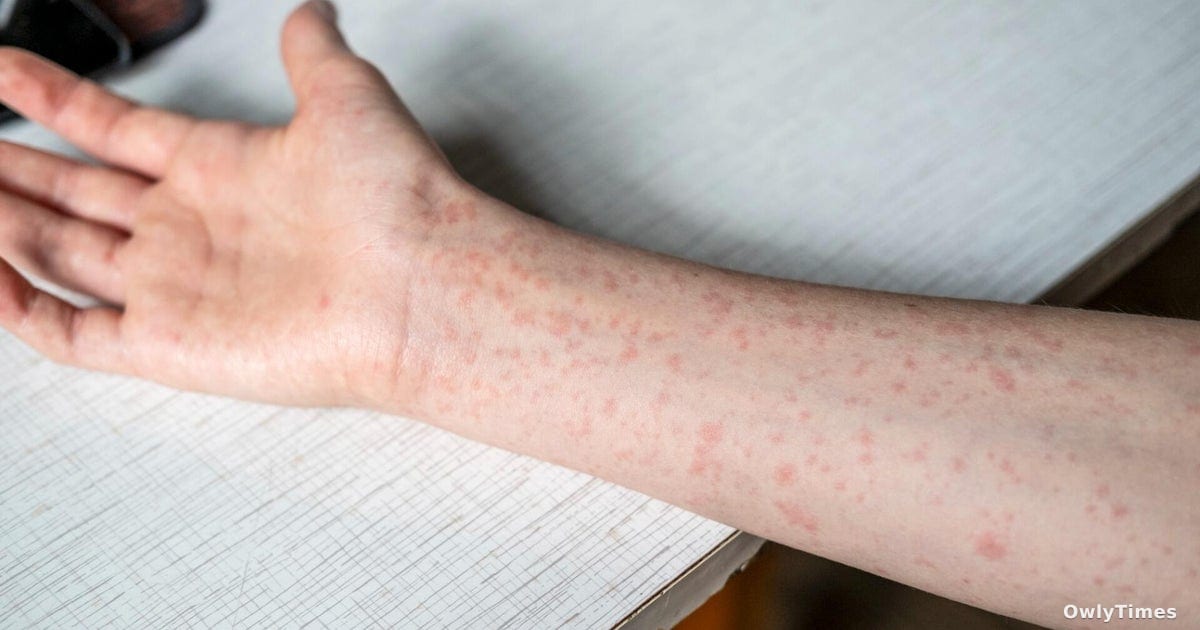 Measles Alerts: A Cook County Immunity Shift? Analysis