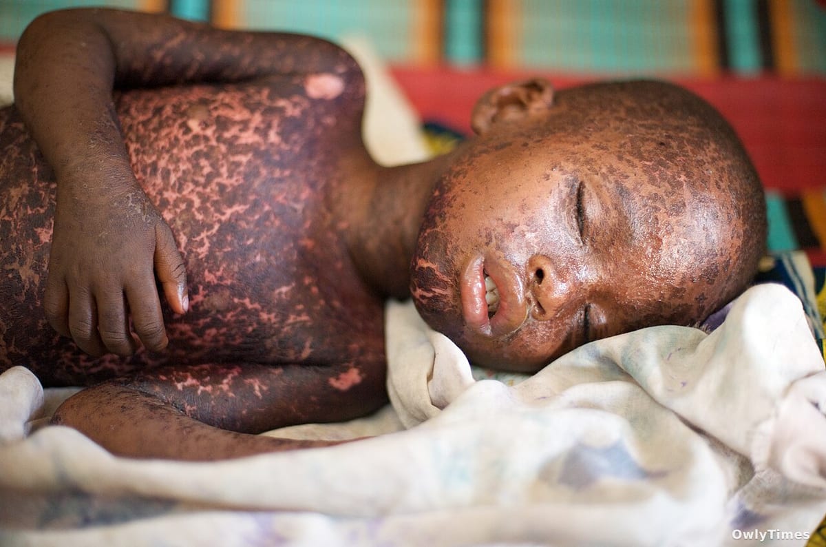 Measles Surge: Economic Stakes Rise as Cases Climb