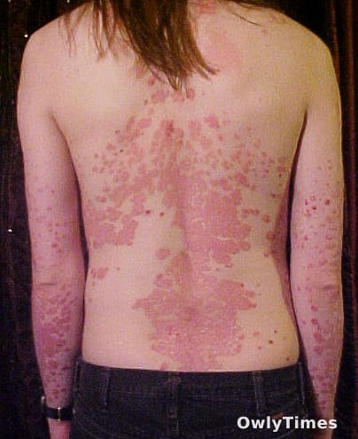 Argenx's $4.2B Surge: Autoimmune Treatment Stakes Rise