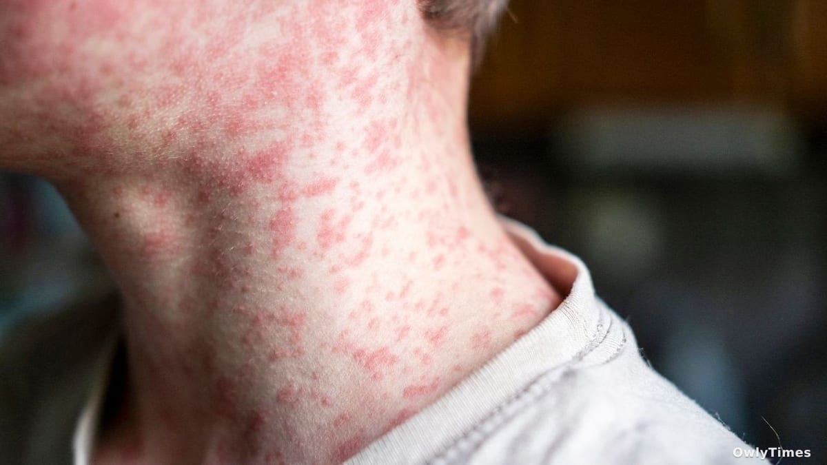 El Paso Measles: A Warning Sign About Immunity Gaps