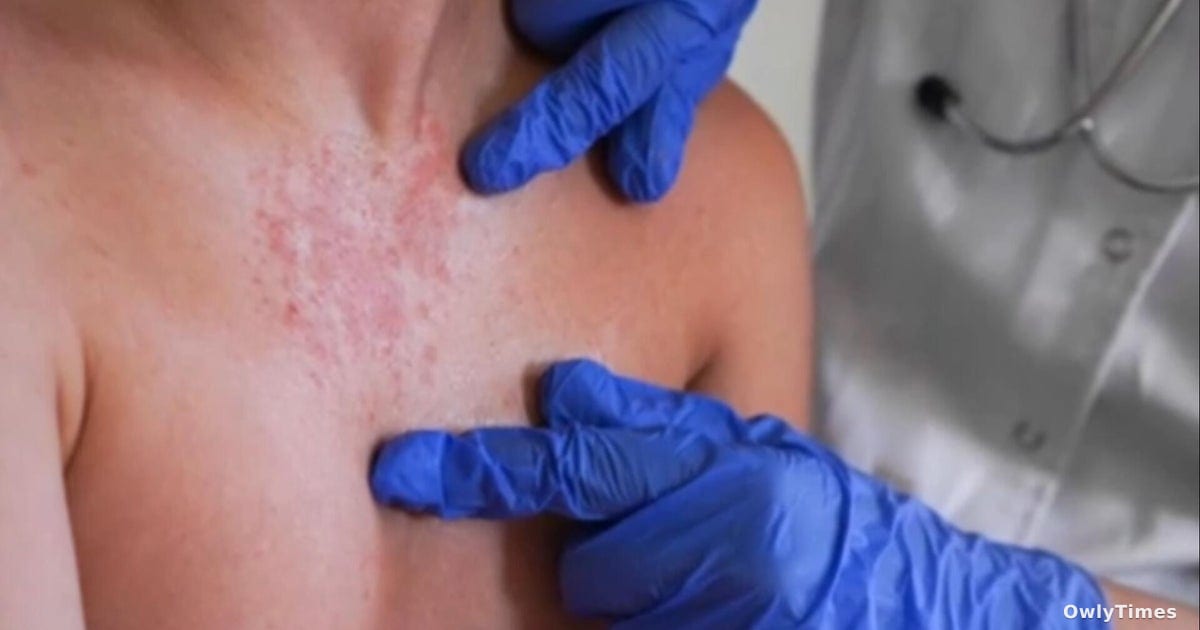 Measles Case Signals Wider Immunity Shift in CA ⚠️