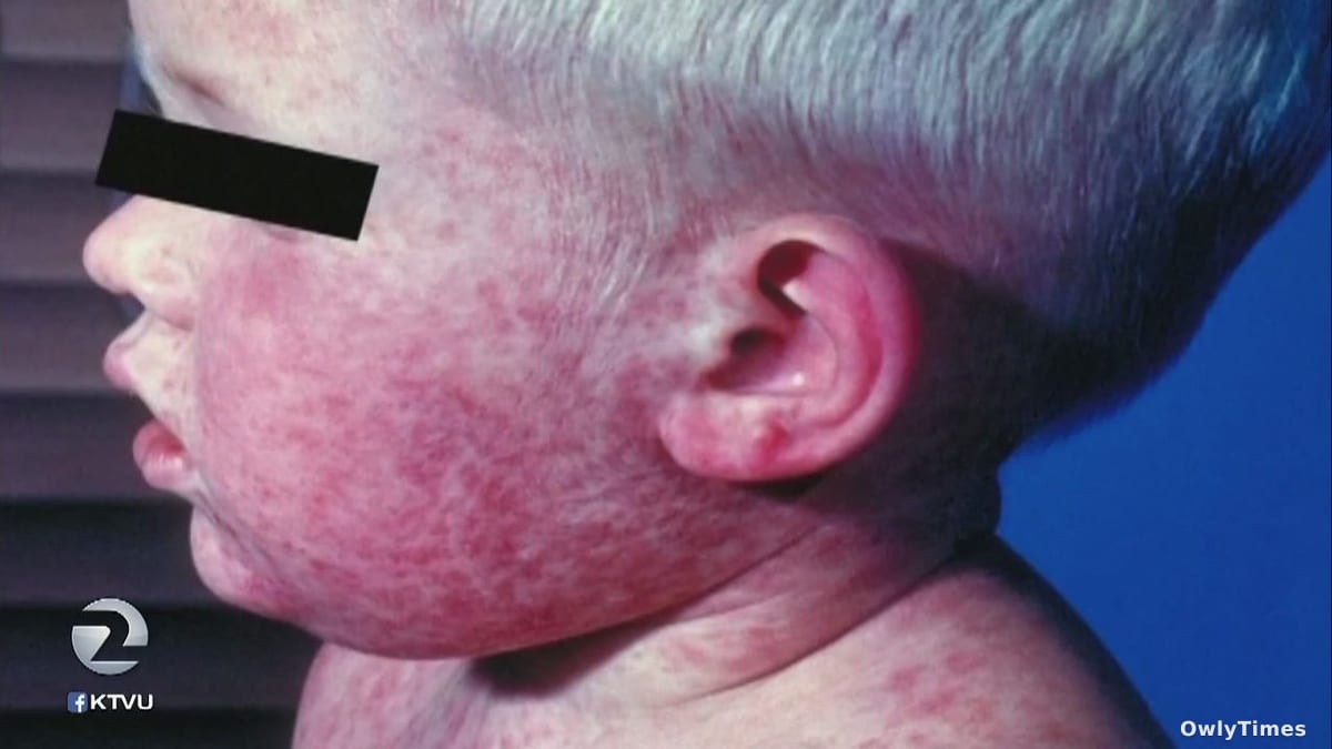 Measles Exposure: A Signal of Weakening Immunity?